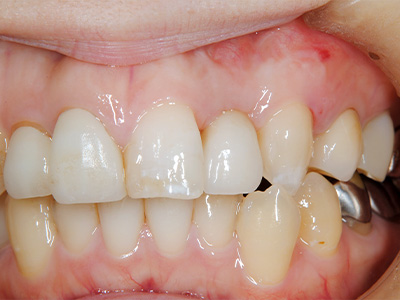 名古屋で実績のある名医による費用を抑えた症例③