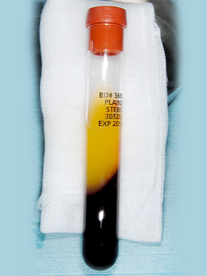 再生医療で難症例でも治療可能