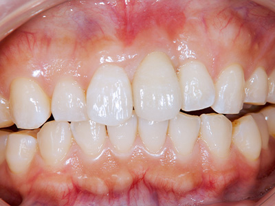 35年以上の実績がある歯科技術で安心｜症例③