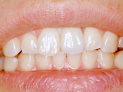 35年以上の実績がある歯科技術で安心｜症例④