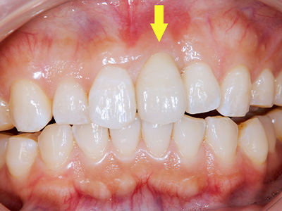 35年以上の実績がある歯科技術で安心｜症例③