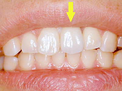 35年以上の実績がある歯科技術で安心｜症例④
