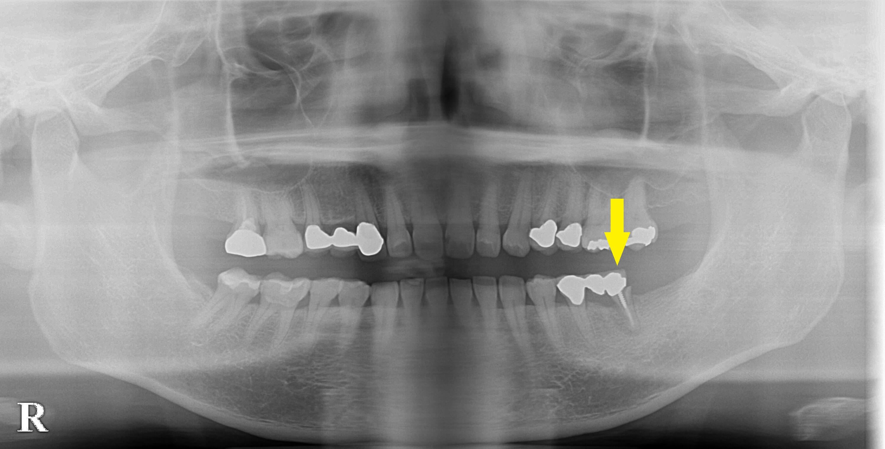 CT画像|インプラント治療で選ばれる名古屋の歯科医院