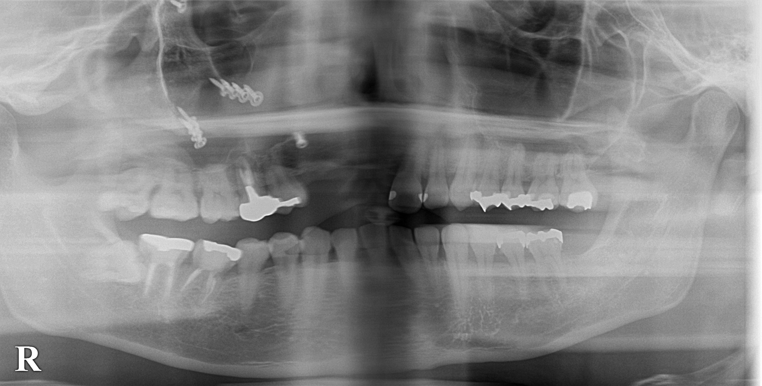 インプラント治療で選ばれる名古屋の歯科医院
