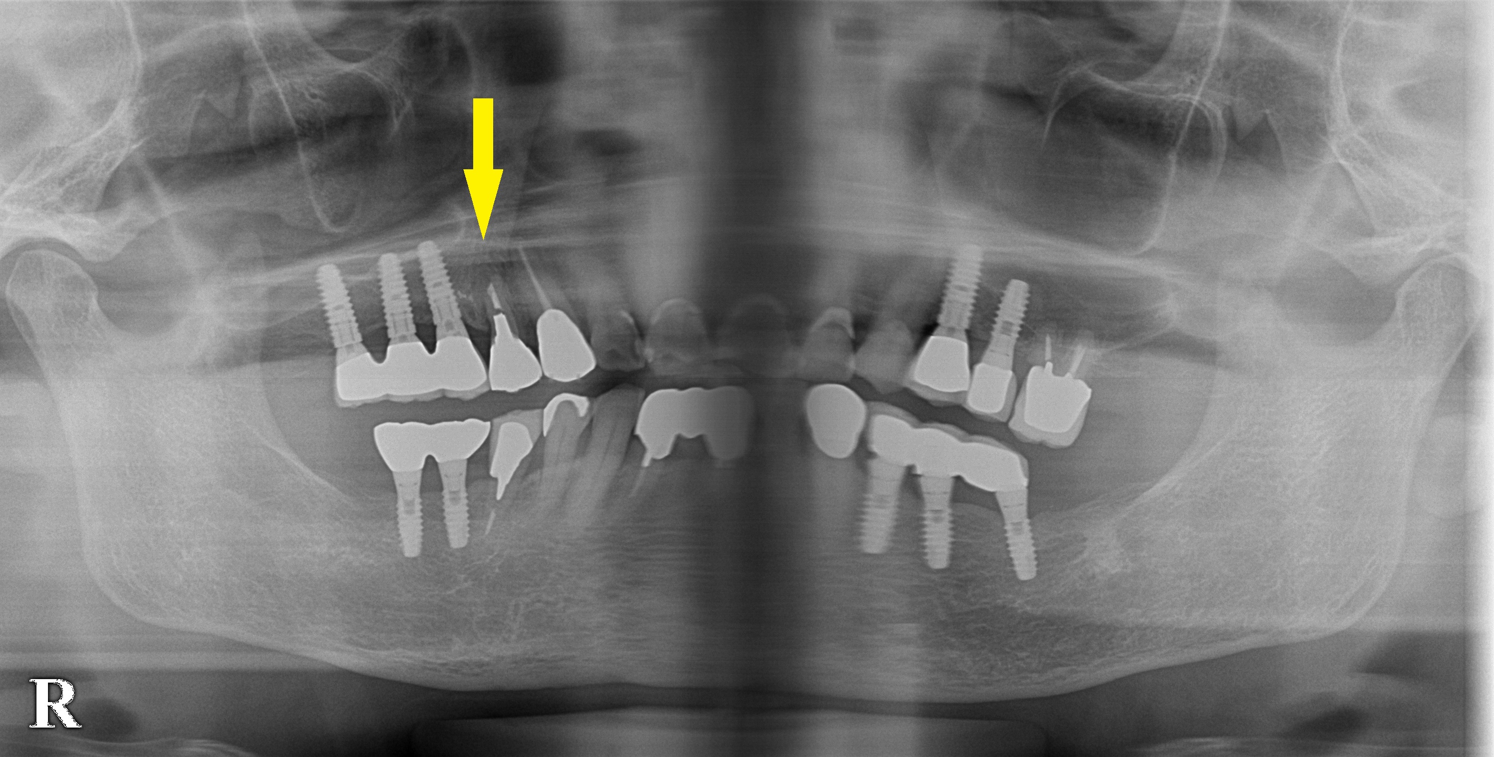 インプラント治療で選ばれる名古屋の歯科医院