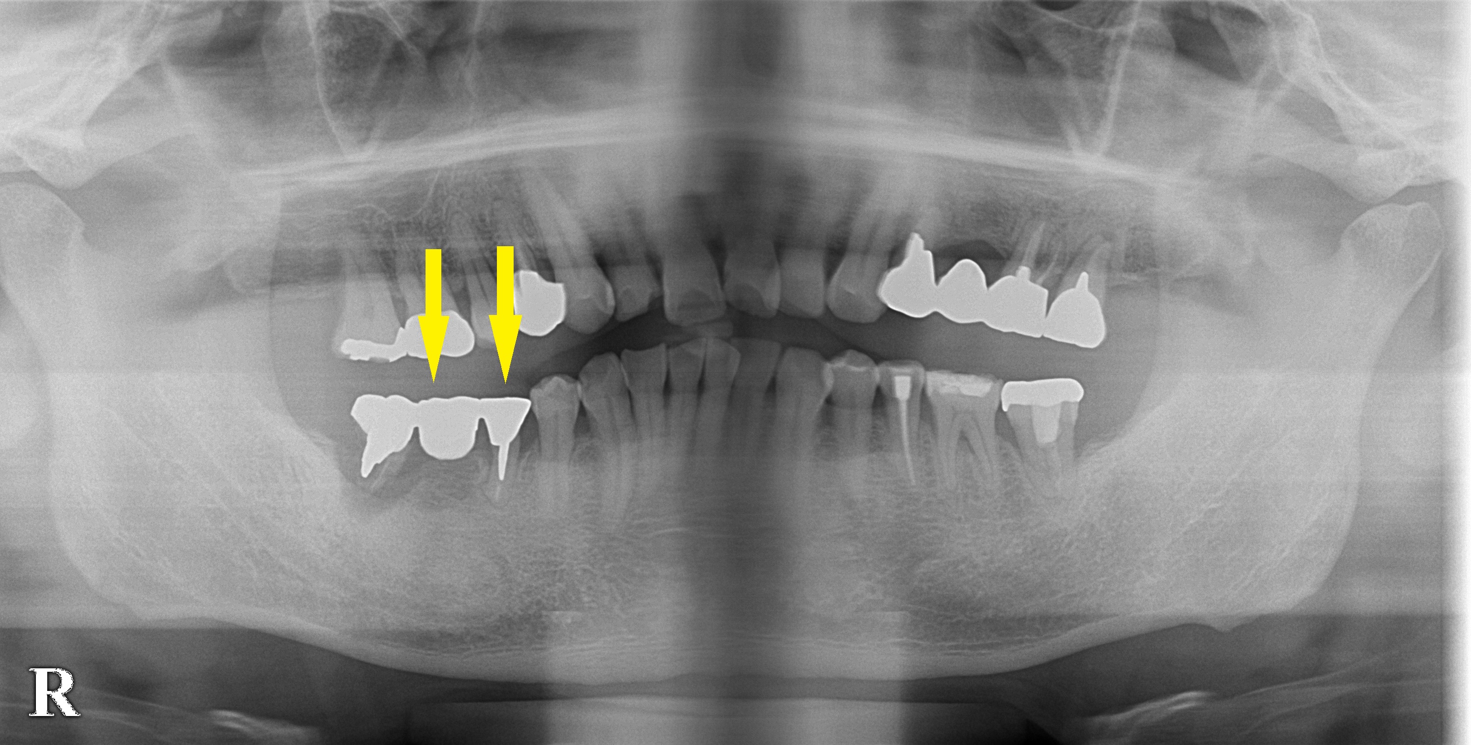 CT写真|インプラント治療で選ばれる名古屋の歯科医院