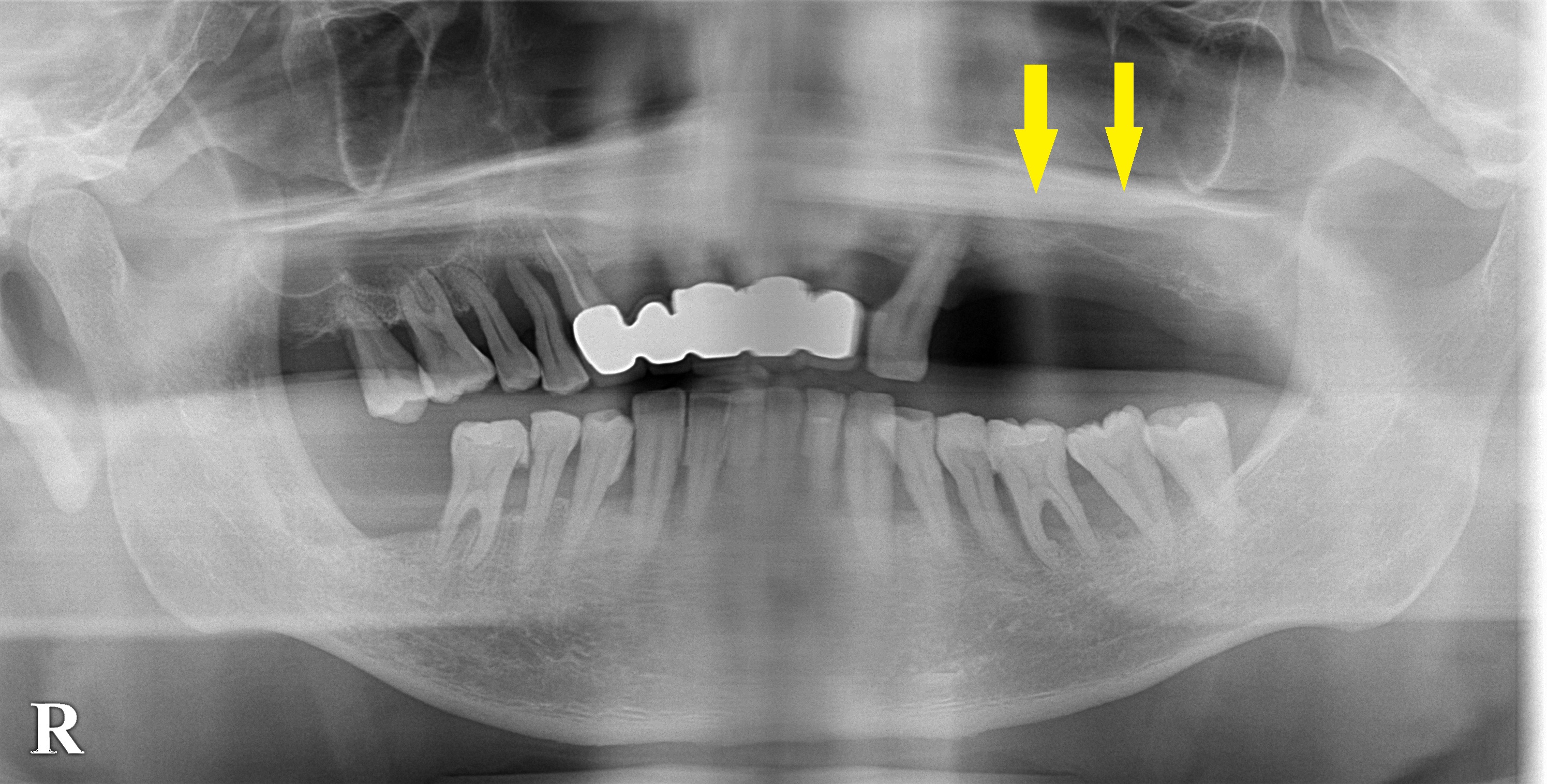 CT写真|インプラント治療で選ばれる名古屋の歯科医院