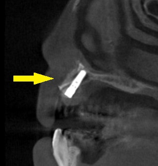 インプラント治療で選ばれる名古屋の歯科医院