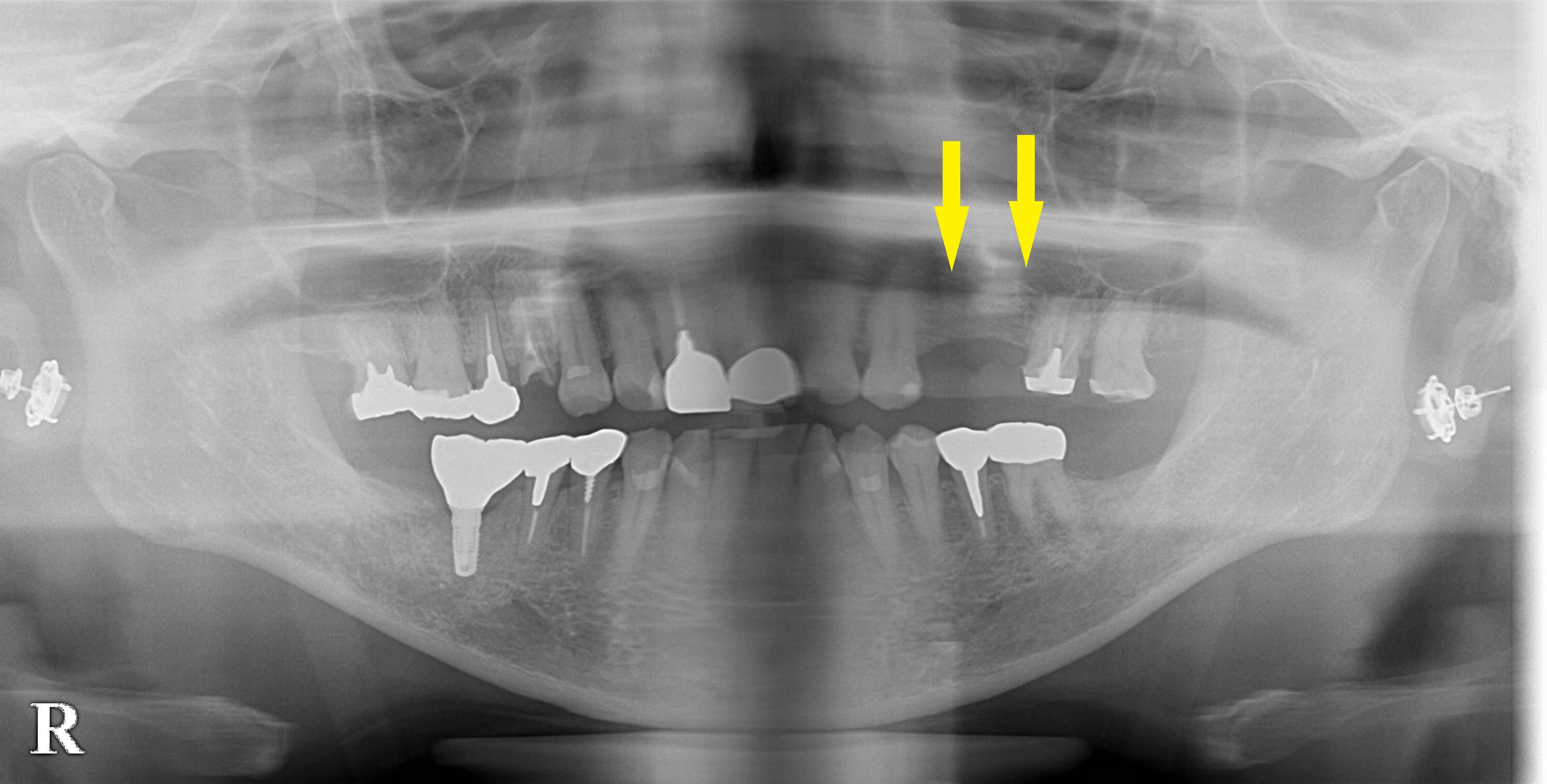 インプラント治療で選ばれる名古屋の歯科医院