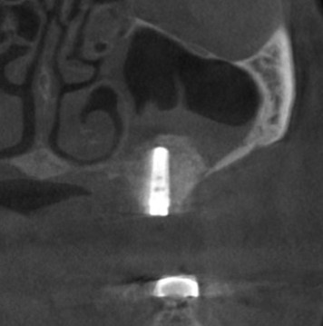 インプラント治療で選ばれる名古屋の歯科医院