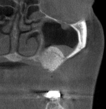 インプラント治療で選ばれる名古屋の歯科医院