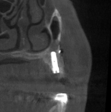インプラント治療で選ばれる名古屋の歯科医院