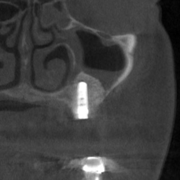 インプラント治療で選ばれる名古屋の歯科医院