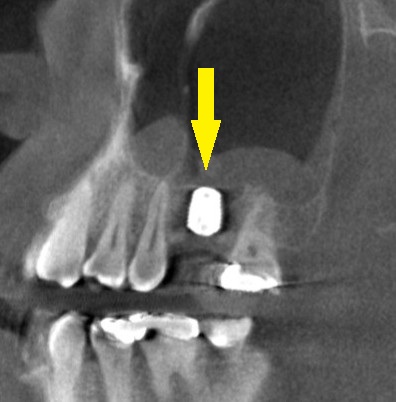 インプラント治療で選ばれる名古屋の歯科医院