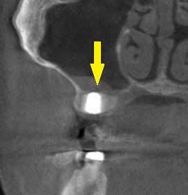 インプラント治療で選ばれる名古屋の歯科医院