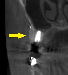 インプラント治療で選ばれる名古屋の歯科医院