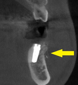 インプラント治療で選ばれる名古屋の歯科医院