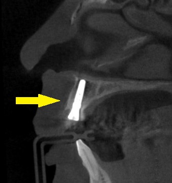 インプラント治療で選ばれる名古屋の歯科医院