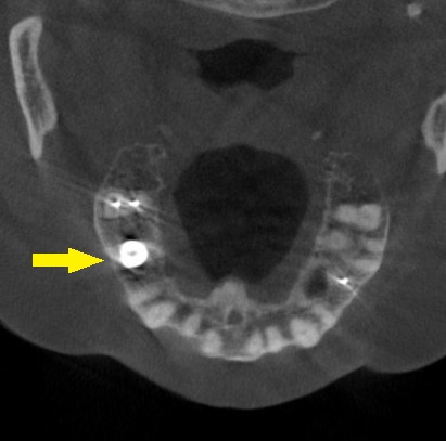 インプラント治療で選ばれる名古屋の歯科医院