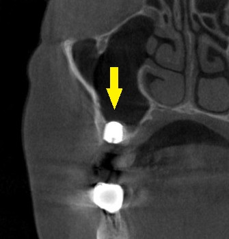 インプラント治療で選ばれる名古屋の歯科医院