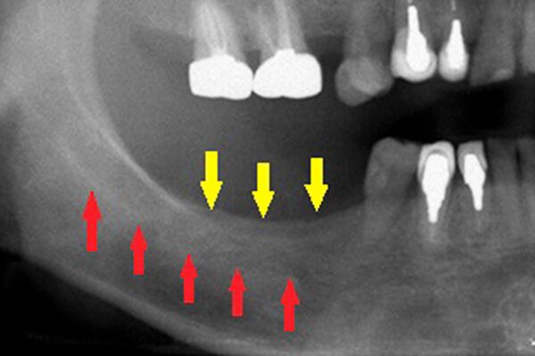 下顎骨の中を通る神経が近接していて骨が不足しているためインプラントの埋入が困難な状況