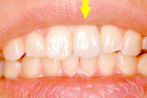 ほとんど天然歯と区別がつかないインプラント