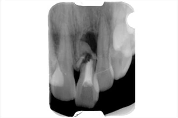 前歯の歯根がボロボロになり周囲の骨が大きく吸収されているレントゲン写真